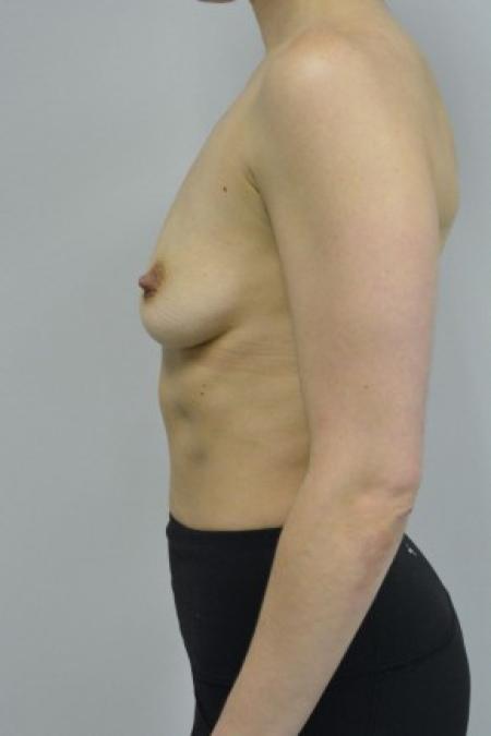 Before image 3 Case #88091 - 34-44 year woman treated with microtextured high profile cohesive silicone gel implants.  