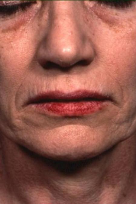 Before image 1 Case #81586 - Chemical Peel / Facelift