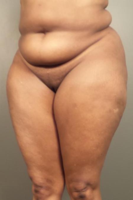 Before image 2 Case #84721 - Abdominoplasty