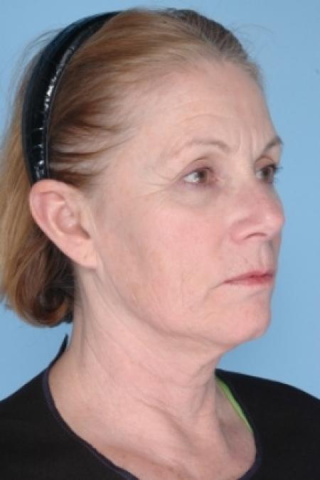 Before image 2 Case #80621 - Ulthera