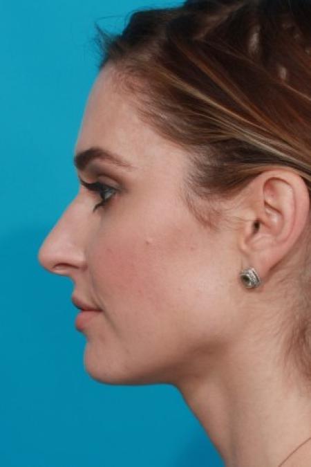 Before image 3 Case #85741 - Open Septorhinoplasty