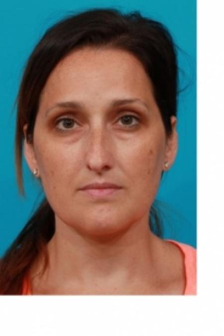 Before image 1 Case #81066 - Open Rhinoplasty