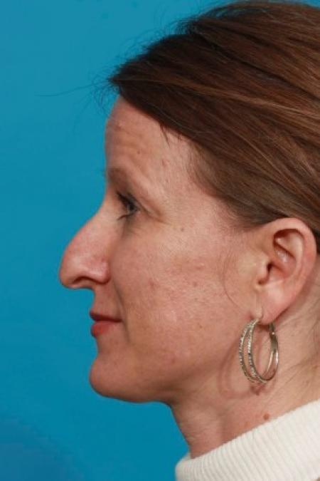 Before image 3 Case #85711 - Open Septorhinoplasty