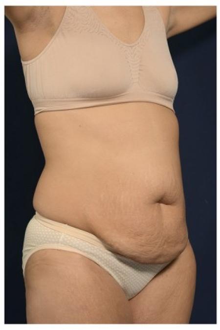 Before image 2 Case #84781 - Abdominoplasty