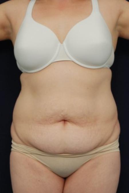 Before image 1 Case #87696 - Abdominoplasty