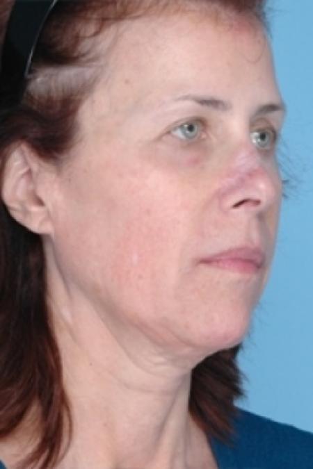 Before image 2 Case #79311 - Non-Surgical Focused Ultrasound