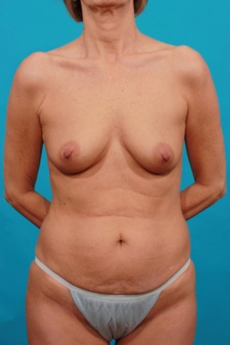 Before image 1 Case #86496 - Mommy Makeover: TT / BA