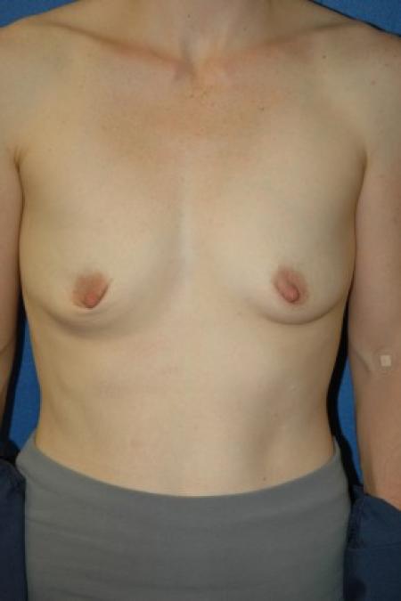 Before image 1 Case #81336 - Breast Augmentation using Allergan Style 410-MF335cc
