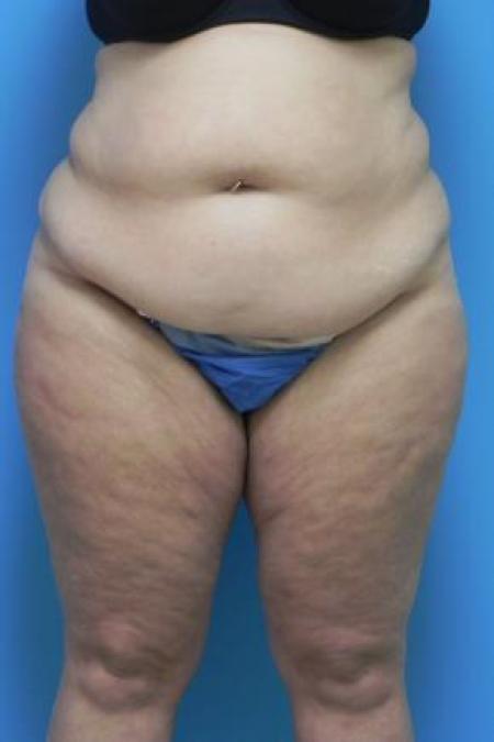 Before Case #80956 - Lower body lift and medial thigh lift