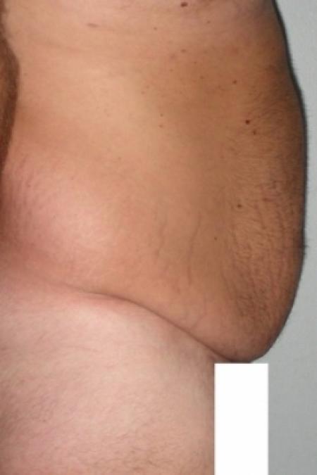 Before image 3 Case #79796 - Male Tummy Tuck
