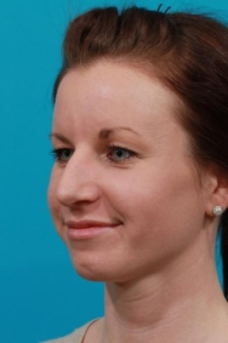 Before image 2 Case #78756 - Rhinoplasty (Nose Reshaping)