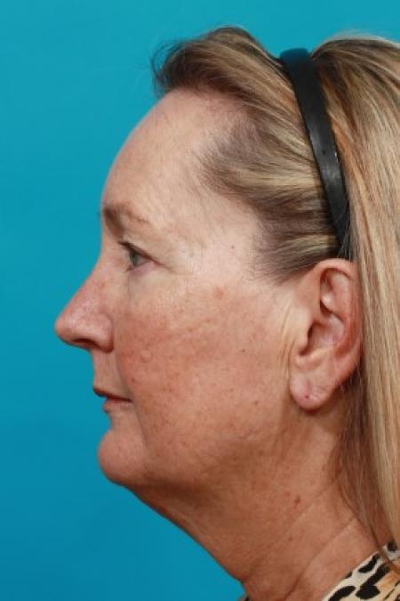 Before image 3 Case #86036 - Quad Blepharoplasty