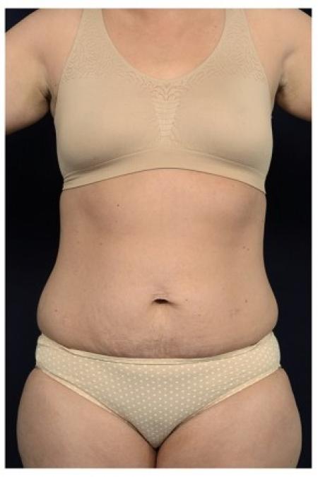 Before image 1 Case #84511 - Abdominoplasty