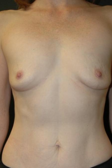 Before image 1 Case #81316 - Breast Augmentation using Allergan Style 15- 286cc