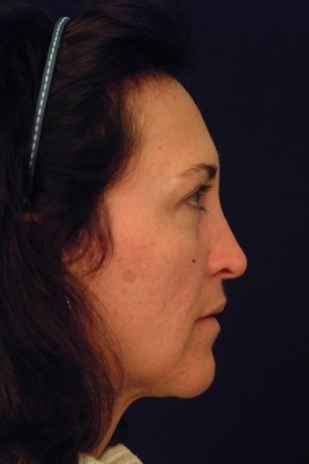 Before image 3 Case #87711 - Structural Fat Grafting