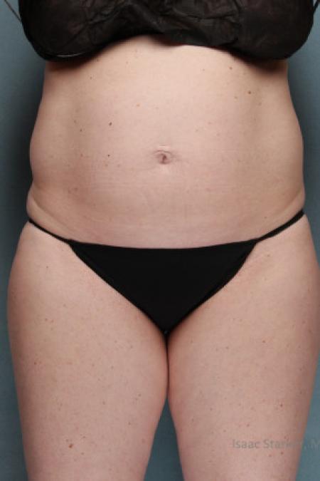 Before image 1 Case #88161 - Tummy Tuck