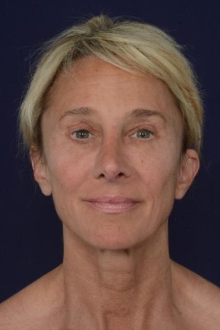 Before image 1 Case #87626 - Structural Fat Grafting