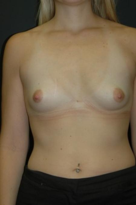 Before image 1 Case #81301 - Sientra Breast Augmentation MP-350cc