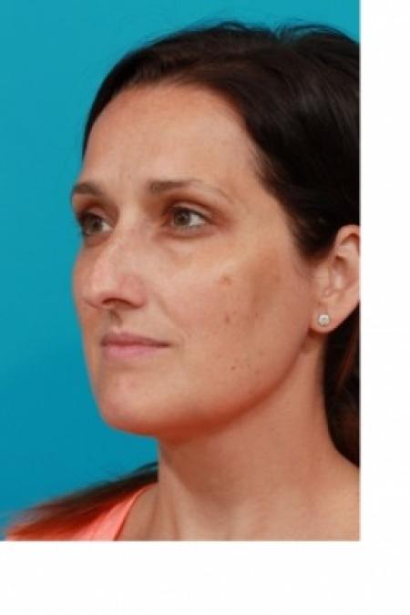 Before image 2 Case #81066 - Open Rhinoplasty