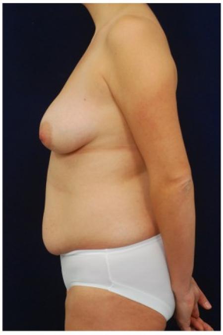 Before image 3 Case #82096 - Mommy Makeover