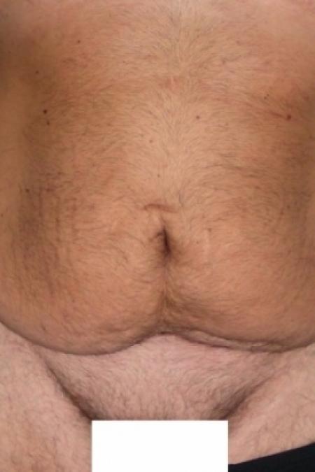 Before image 1 Case #79796 - Male Tummy Tuck