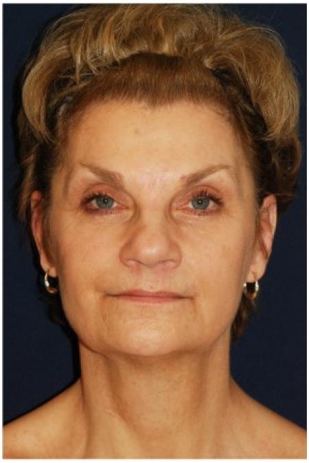 Before image 1 Case #82046 - Full Facial Rejuvenation