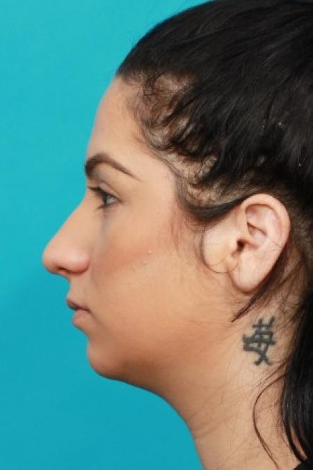 Before image 3 Case #83921 - Rhinoplasty with Chin Augmentation