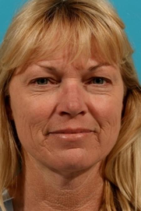 Before image 1 Case #78941 - Upper Eyelid Blepharoplasty