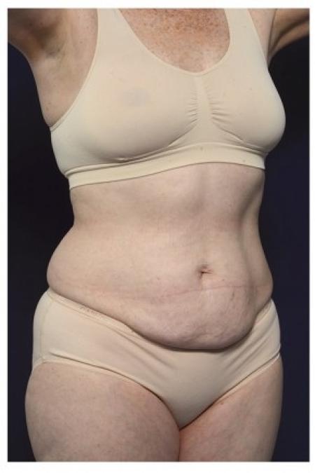 Before image 2 Case #85606 - Abdominoplasty