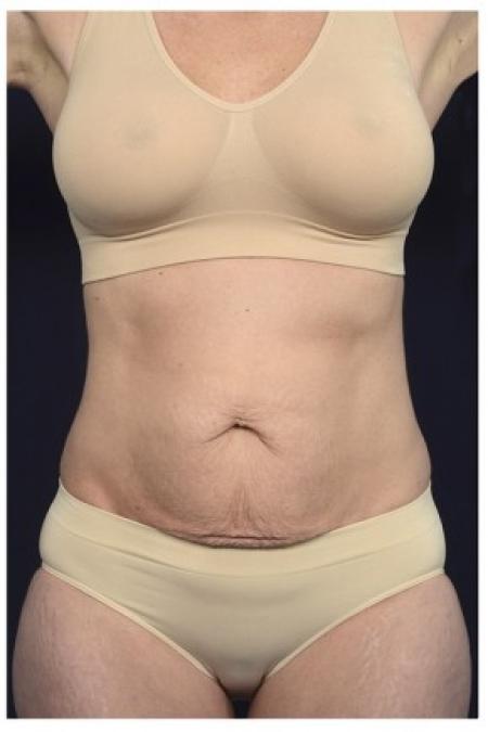 Before image 1 Case #86201 - 40 year old woman treated with an Abdominoplasty