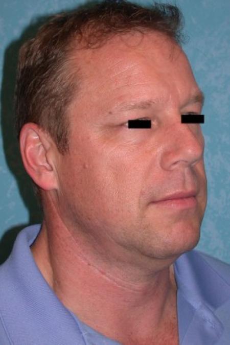Before image 1 Case #81381 - Lower Face and Neck Lift with Upper and Lower Blepharoplasties