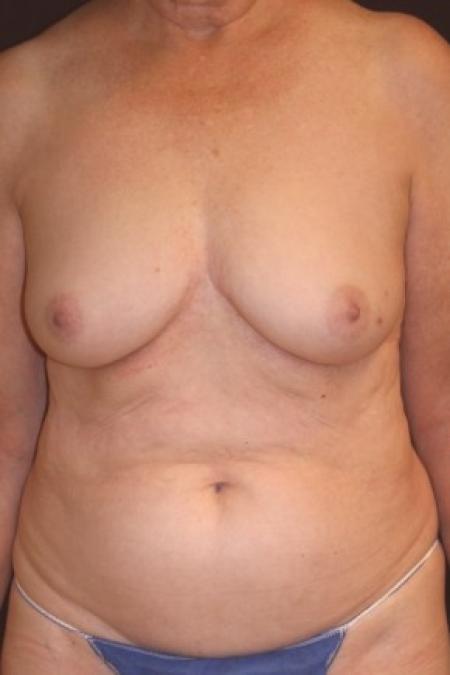 Before image 1 Case #84946 - 72 y/o - Immediate Left DIEP Breast Flap Reconstruction