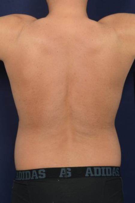 Before image 3 Case #87591 - Trunk Liposuction
