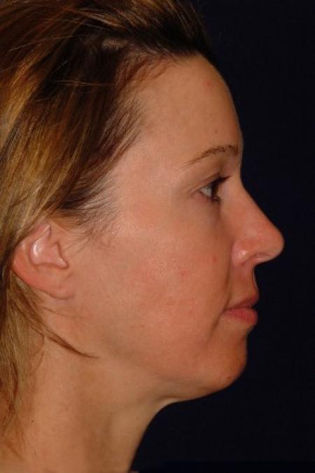 Before image 3 Case #87661 - Full Facial Rejuvenation