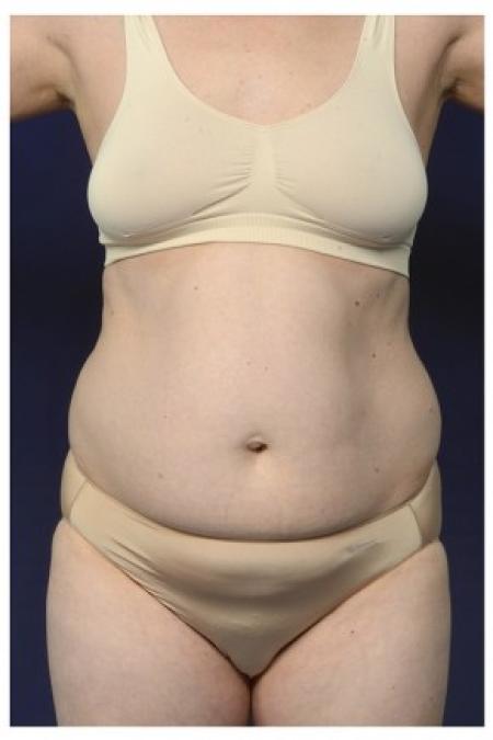 Before image 1 Case #84496 - Abdominoplasty