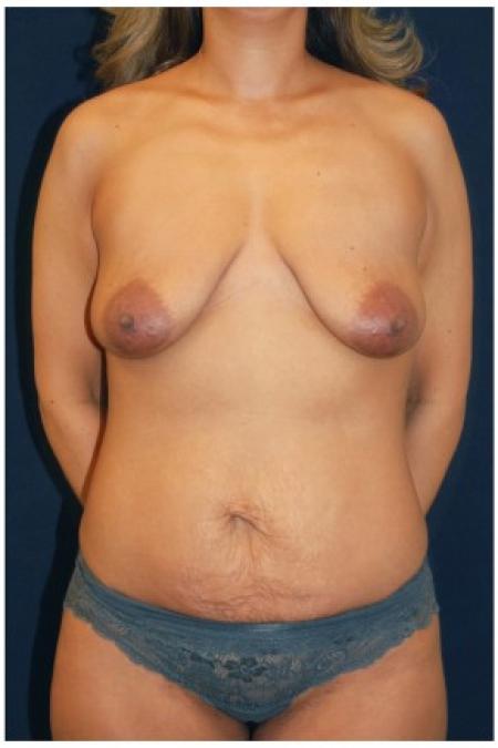 Before image 1 Case #82156 - Mommy Makeover