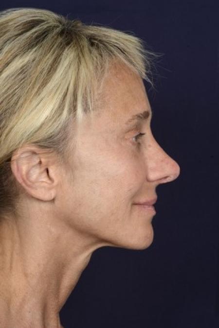 Before image 3 Case #87126 - Structural Fat Grafting