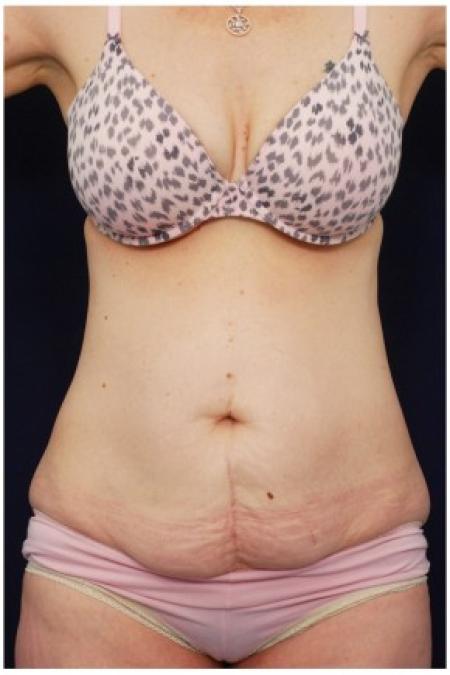 Before image 1 Case #82131 - Tummy Tuck