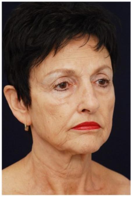 Before image 2 Case #82031 - Facelift