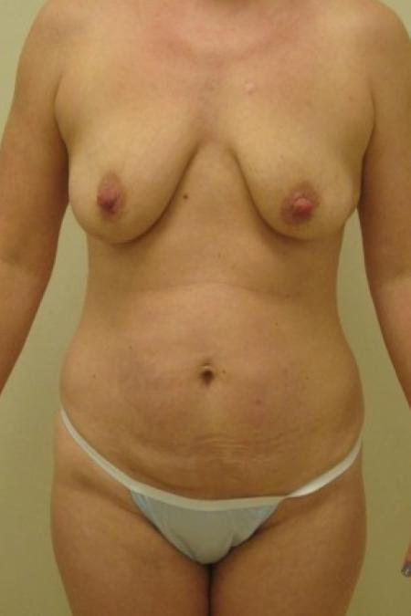 Before image 1 Case #82781 - Abdominoplasty, Breast Augmentation and Mastopexy