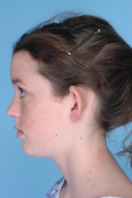Before image 2 Case #79521 - Ear Surgery