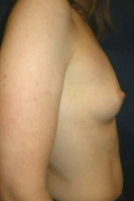 Before image 3 Case #82891 - Breast Augmentation using Smooth Round Silicone Gel Implants