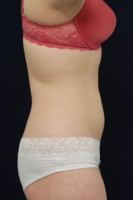 Before image 3 Case #87726 - Liposuction