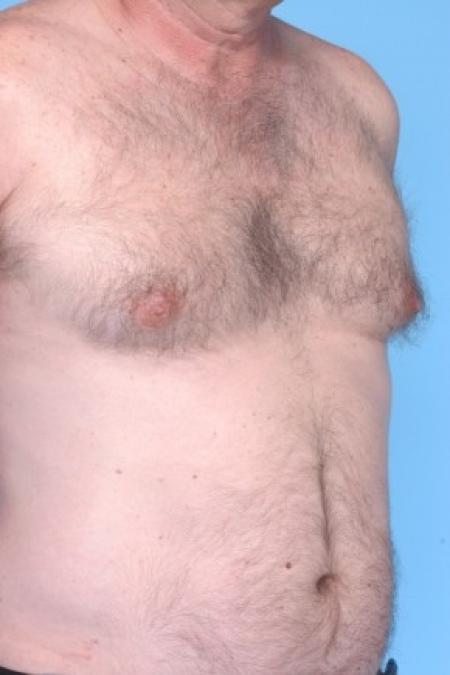 Before image 1 Case #81211 - Liposuction