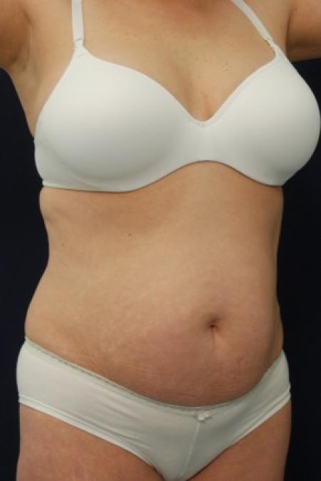 Before image 2 Case #87646 - Abdominoplasty