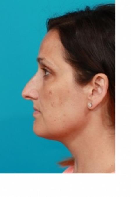 Before image 3 Case #81066 - Open Rhinoplasty