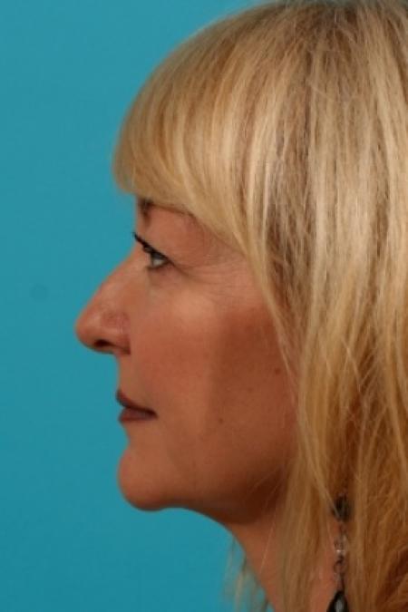 Before image 2 Case #78931 - Upper Eyelid Blepharoplasty