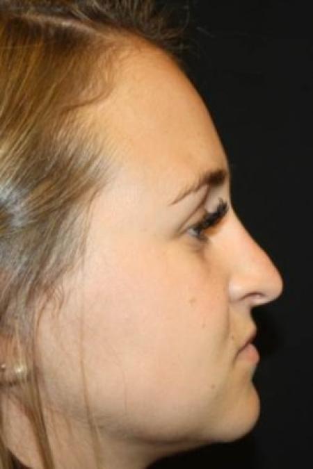 Before image 3 Case #84211 - Rhinoplasty - 24 year old female.