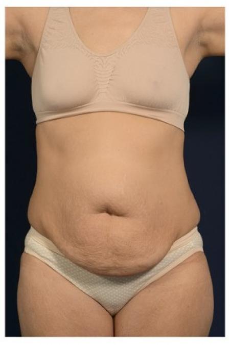 Before image 1 Case #84781 - Abdominoplasty