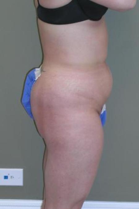 Before image 2 Case #80851 - Liposuction
